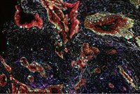 Cómo se desarrolla el cáncer de páncreas: posibles nuevas terapias