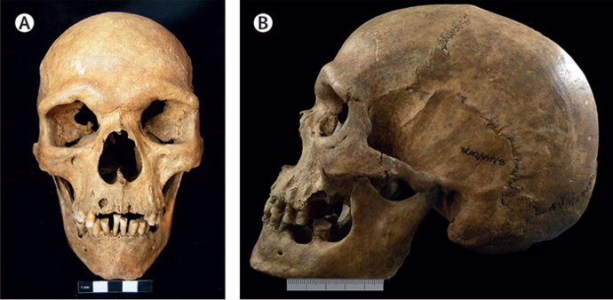 Las fotografías del cráneo muestran vistas anteriores (A) y laterales (B) con una probable maloclusión y prognatismo maxilar denunciado por un desgaste dental atípico.