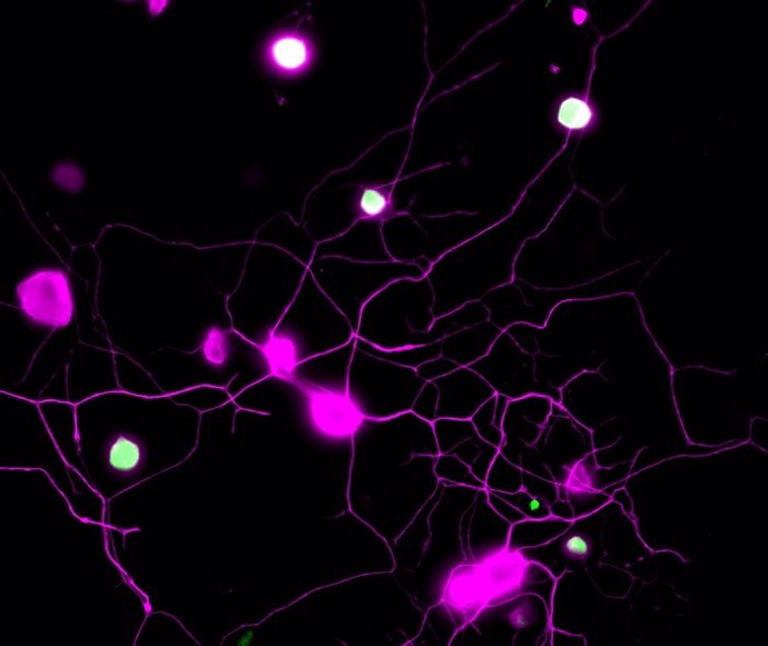 Las neuronas sensoriales del ratón se muestran en magenta. BH4, la molécula que provoca el dolor crónico, se muestra en verde. Por lo tanto, las neuronas "en dolor" se ven en verde/blanco.