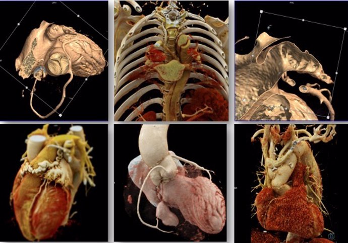 Archivo - Reconstrucciones volumétricas de TC cardiaca