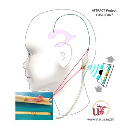 Desarrollan una nueva tecnología para prevenir obstrucciones en catéteres de pacientes con hidrocefalia