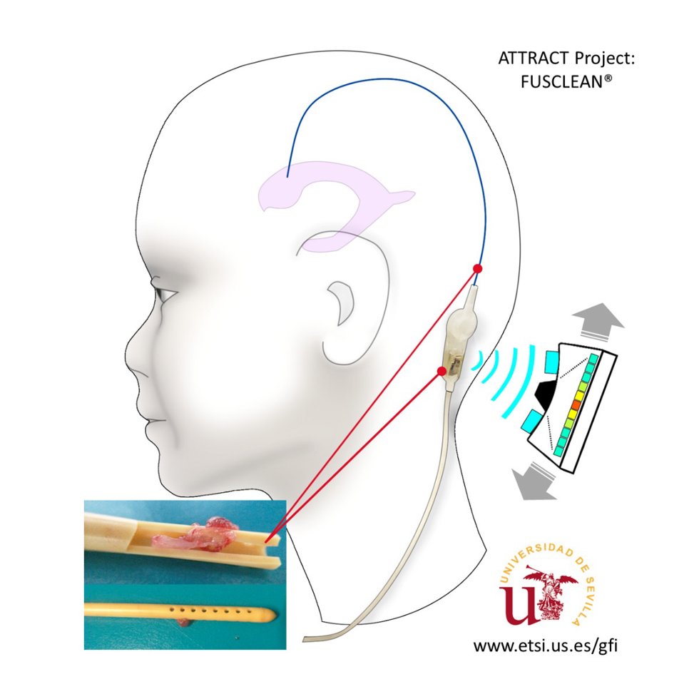 Desarrollan una nueva tecnología para prevenir obstrucciones en catéteres de pacientes con hidrocefalia