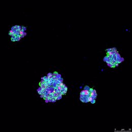 Archivo - Glioblastoma, células.