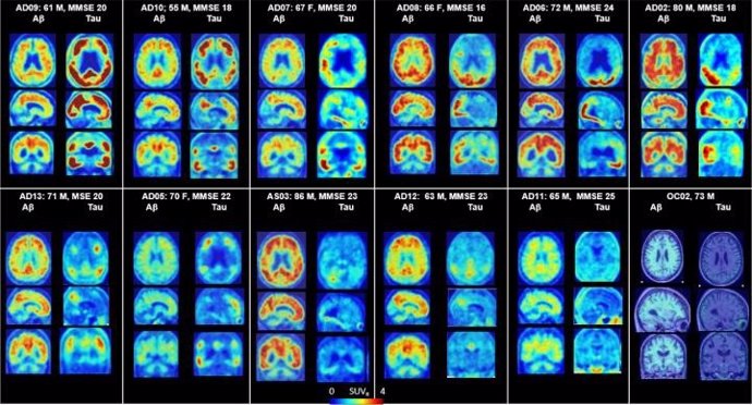 Archivo - PET del cerebro que muestra placas amiloides y proteínas tau en Alzheimer