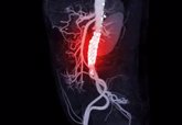 Foto: Confirman el bajo riesgo a largo plazo de la mayoría de los aneurismas de aorta torácica