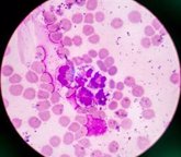 Foto: Detectar precozmente clones hematopoyéticos con una potencial transformación maligna, supone un avance muy importante