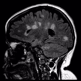 Archivo - Cicatrización del cerebro en la esclerosis múltiple