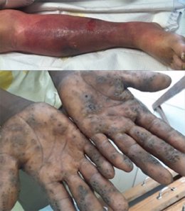 Arriba: Celulitis de una extremidad. Abajo: queratólisis severa con fóvea en las palmas.