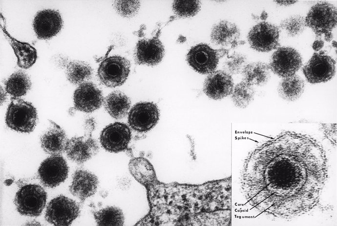 Archivo - Herpesvirus humano 6