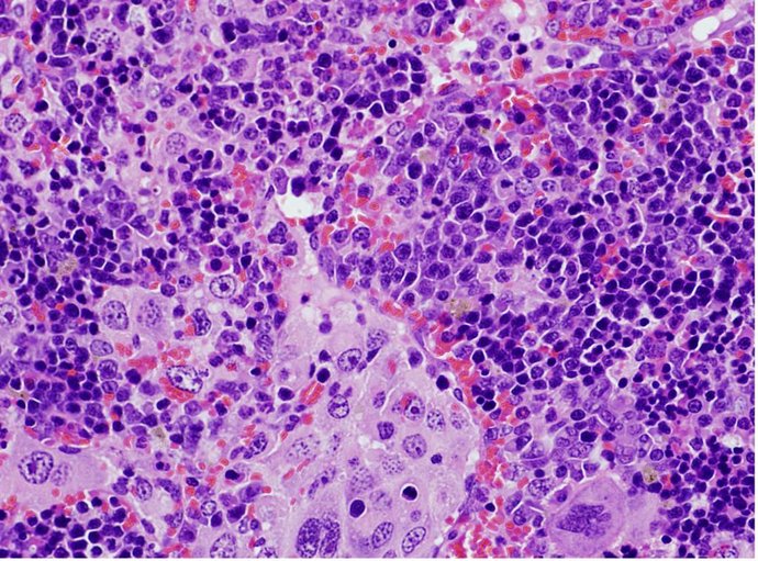 Imagen de microscopía de un bazo que presenta un linfoma desarrollado por ratones que expresan una mutación oncogénica en el gen VAV1.