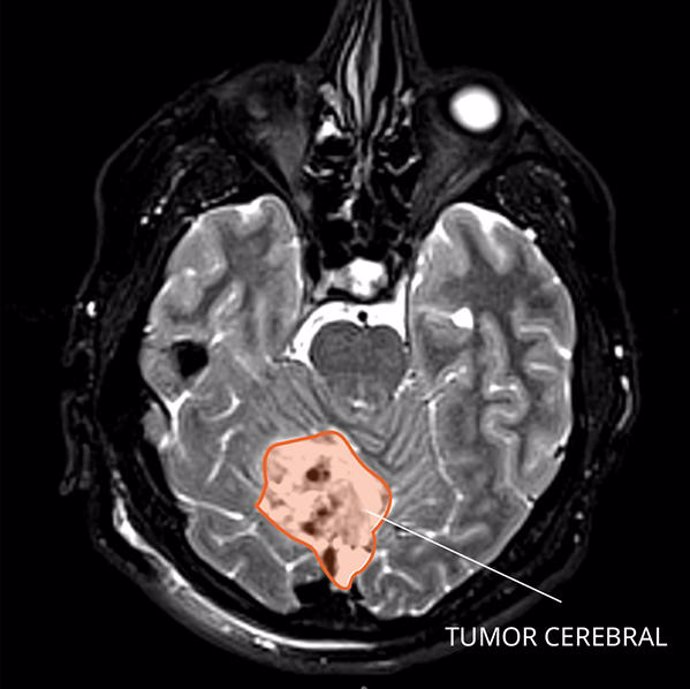 Archivo - Imagen por resonancia magnética de un meduloblastoma en el cerebro.
