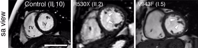 Imágenes de resonancia magnética cardíaca de un familiar sano (izquierda) y dos pacientes de cardiomiopatía no compactada (centro y derecha). Se pueden apreciar las trabéculas características de la enfermedad señaladas con puntas de flecha.