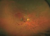 Foto: La retinopatía diabética es la primera causa de ceguera legal entre los 20 y los 65 años en los países industrializados