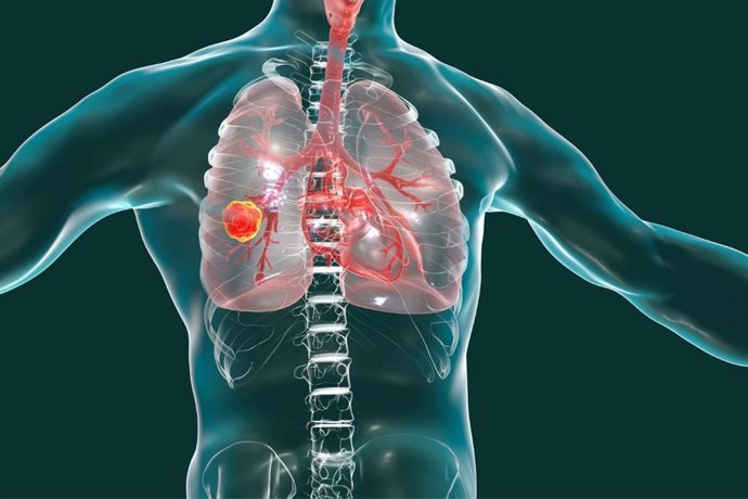 Archivo - Cáncer de pulmón.