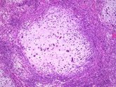 Foto: Identifican cómo células inmunitarias contribuyen a peor supervivencia en pacientes de cáncer de mama HER2-positivo