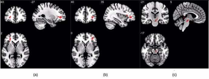 Los anormalidades (a) y (b) se observan en la sustancia blanca cerebral cerca de la circunvolución orbitofrontal, mientras que (c) se encuentra en la región del cerebro medio.