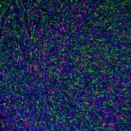 Tumor con células cancerosas deficientes en FMRP (en verde) que son infiltradas y adheridas por células T asesinas (CD8).