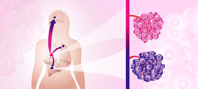 La imagen muestra un tumor primario de cáncer de mama (rosa) y los tumores metastásicos/secundarios (púrpura).