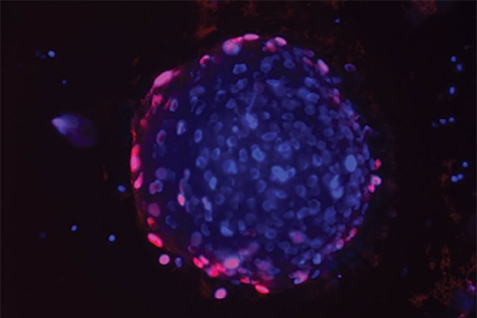 Un organoide de cáncer de próstata. Cuando se cultiva con células inmunitarias de pacientes con cáncer de próstata, que han sido tratados con el fármaco, las células inmunitarias atacan al cáncer. El rojo muestra células muertas. El azul ADN.