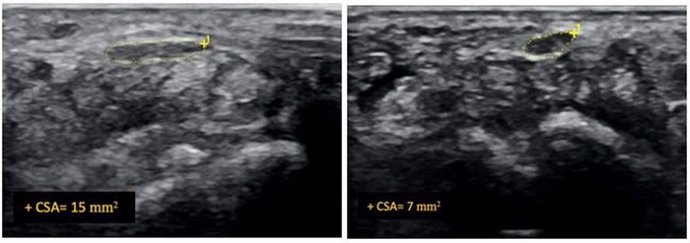 Imagen ecográfica del nervio mediano antes y después del procedimiento de hidrodisección en un paciente con síndrome del túnel carpiano.