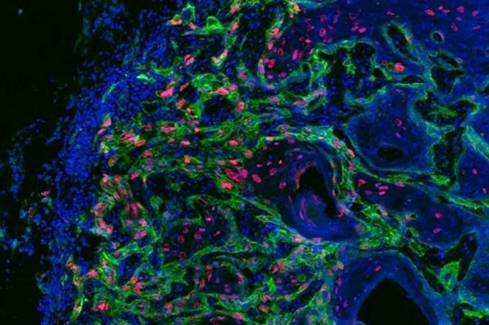 La señalización del TGF beta (rojo) es una de las formas en que el entorno hace que las células madre del cáncer en el límite entre el estroma y el tumor (verde) se vuelvan invasivas. Las células vivas se tiñen de azul.