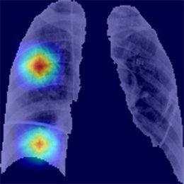 Archivo - Resultados de segmentación automática de los pulmones e identificación de regiones de interés en paciente con covid-19.