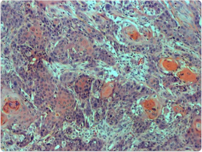 Corte transversal de un tumor carcinoma de células escamosas de cabeza y cuello de un paciente con anemia de Fanconi.