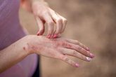 Foto: Un nuevo tratamiento para la dermatitis atópica de moderada a grave muestra resultados prometedores a largo plazo
