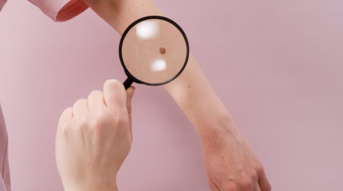 Un estudio identifica una estrategia terapéutica contra un subtipo de melanoma sin tratamiento