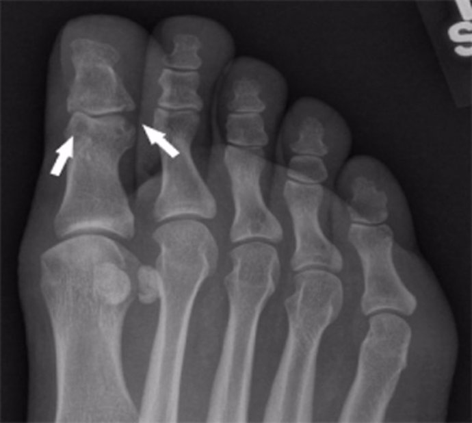 Archivo - Una radiografía del pie de un paciente con gota, que reveló erosiones articulares punzantes en el dedo gordo, rasgos característicos de la gota tofácea erosiva.