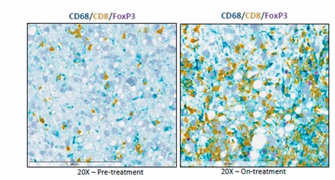 Biopsias obtenidas antes y después del tratamiento de pacientes del ensayo: en amarillo las células T infiltrando el tumor