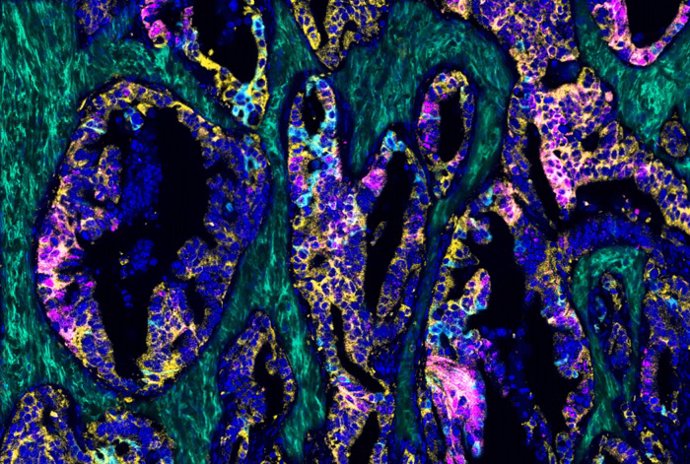 Imagen de cáncer colorrectal rico en ácido hialurónico. Las células tumorales altamente agresivas (turquesa y magenta) son negativas para ambas aPKC (amarillo). El depósito de hialuronano en el estroma se marca en verde, y los núcleos en azul
