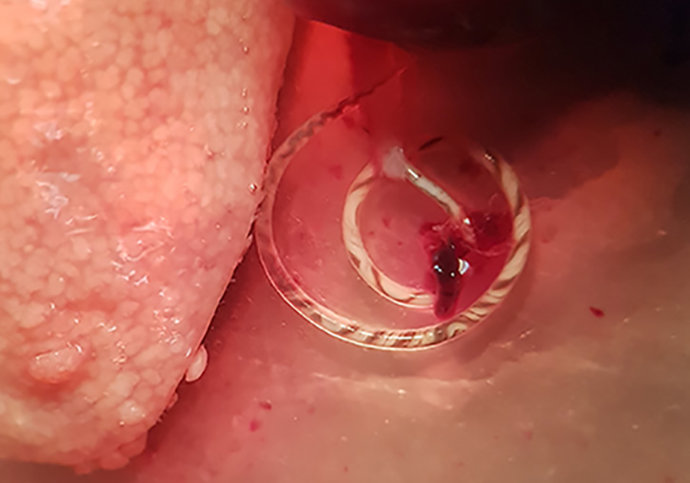 Angiostrongylus cantonensis emergiendo de la arteria pulmonar de una rata capturada en zona de huerta de Valencia 