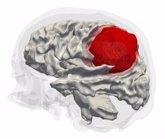 Foto: Hallan tres nuevos subtipos de tumores cerebrales que podrían ayudar a identificar terapias nuevas y efectivas