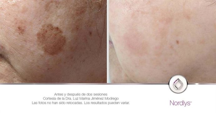 Antes y después con 2 sesiones de Nordlys.