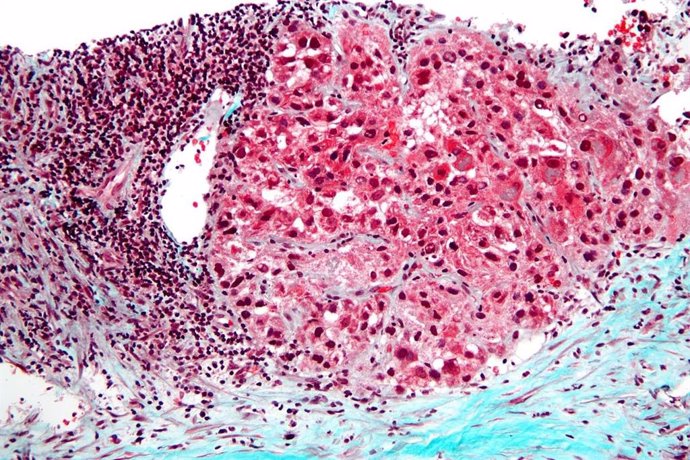 Archivo - Imagen de microscopio que muestra un carcinoma hepatocelular, el tipo más común de cáncer de hígado.