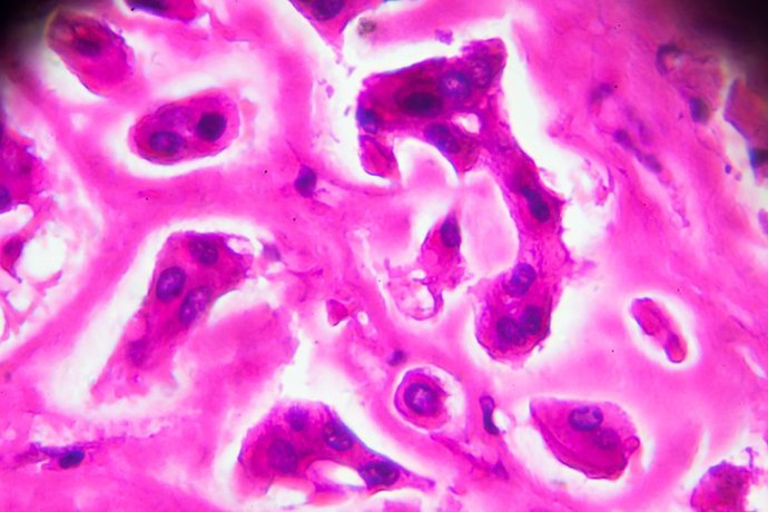 Archivo - Muestra patológica cutis de la lepra de los lepromatosa bajo microscopia ligera