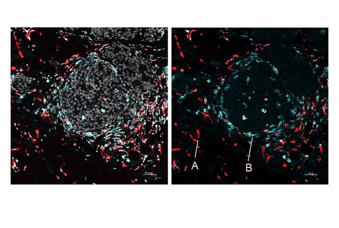 Imagen de células de cáncer de mama humano que muestra A) macrófagos inmunosupresores cerca del tejido conjuntivo tumoral, y B) macrófagos inmunoestimuladores cerca de los nidos tumorales.