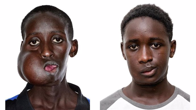 Una acción solidaria salva la vida a un adolescente senegalés tras extirparle un tumor facial de 20 centímetros