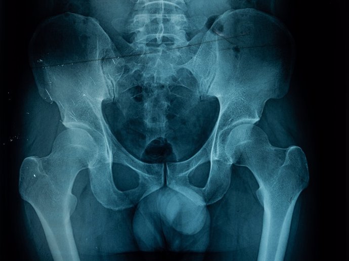 Archivo - Imagen de rayos X de Pelvis