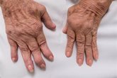 Foto: Los pacientes con artritis psoriásica presentan con más frecuencia obesidad, uveítis y depresión