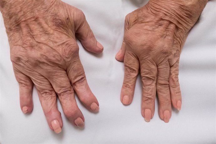 Archivo - La inflamación persistente provocada por la artritis reumatoide puede acabar dañando los huesos, ligamentos y tendones que hay alrededor provocar una deformidad progresiva de las articulaciones