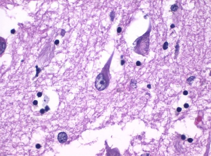 Imagen de tejidos del hipocampo cerebral que muestra ovillos neurofibrilares, un conglomerado anormal de proteínas que se forman por la múltiple fosforilación de tau en pacientes con alzhéimer. /