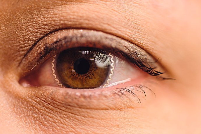 Archivo - Nueva tecnología de lentes de contacto blandas inteligentes que recogen importantes mediciones de la presión intraocular durante ciclos de 24 horas como forma de detectar el glaucoma.