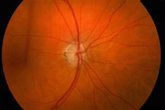 Foto: El problema del glaucoma, segunda causa de ceguera en España, y una enfermedad silenciosa que no avisa: cómo detectarla