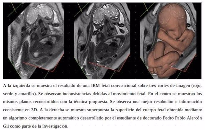 Crean una técnica de reconstrucciones en 3D del útero que podría permitir un diagnóstico más fiable de anomalías fetales