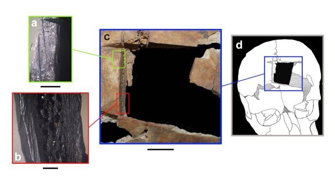 Detalle de la trepanación identificada en el cráneo objeto de estudio