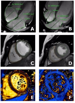 Imágenes del corazón obtenidas mediante resonancia magnética en las que se analizan distintas estructuras de la anatomía y función del corazón: aurículas (A y B), ventrículos (C y D), características del tejido cardiaco (E y F).
