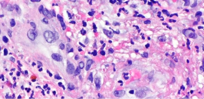 Células afectadas por vasculitis linfocítica.