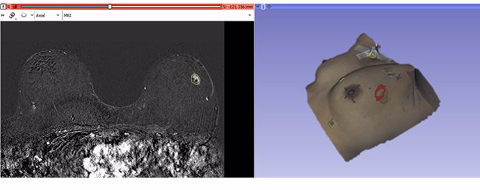 La técnica está implementada para su inclusión en una herramienta capaz de representar los modelos 3D de la escena intraoperatoria, incluyendo la superficie intraoperatoria, la posición estimada de la lesión y su proyección en piel.